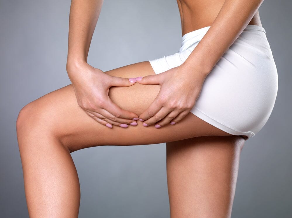 Understanding and Treating Cellulite