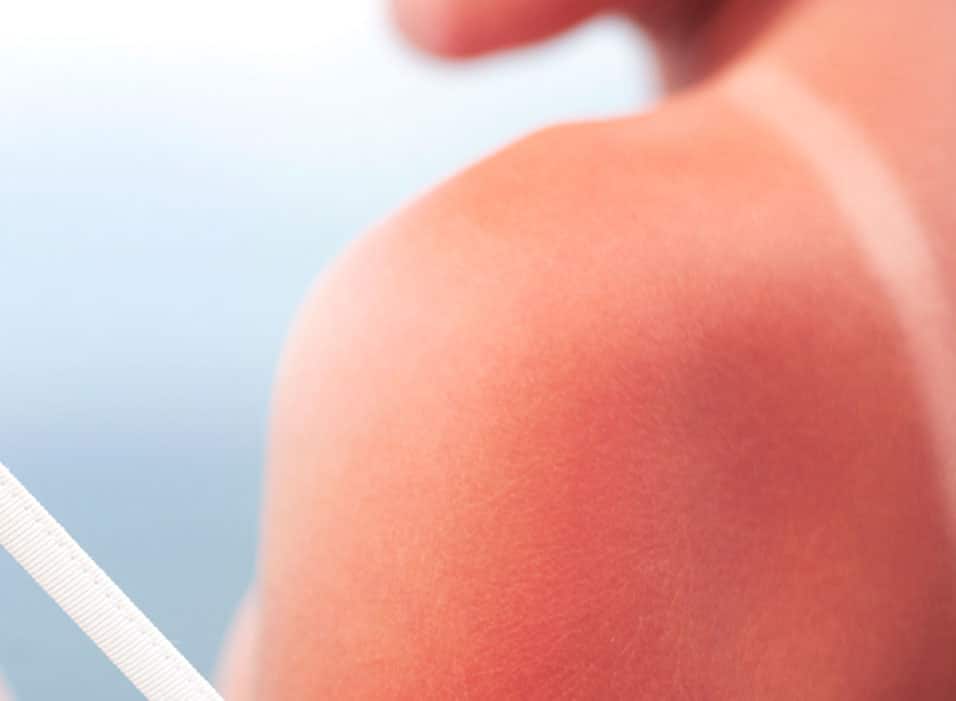 Natural Sunburn Remedies: Soothing After-Sun Skin Care